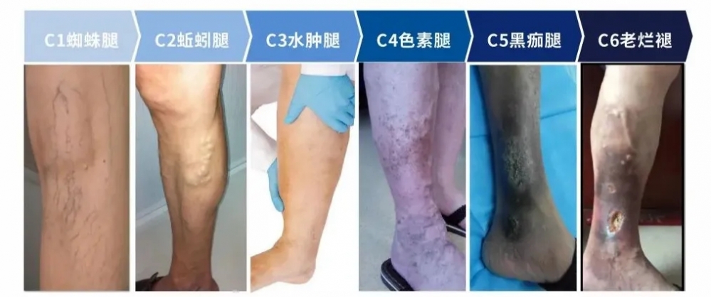 弹力袜,不是,瘦腿,袜,穿,对了,才能,护,住,这,条,功勋,血管{bbname}bbs.ahv.cc