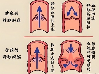 腿上“青筋暴起”？别不当回事！ 血管外科{bbname}bbs.ahv.cc