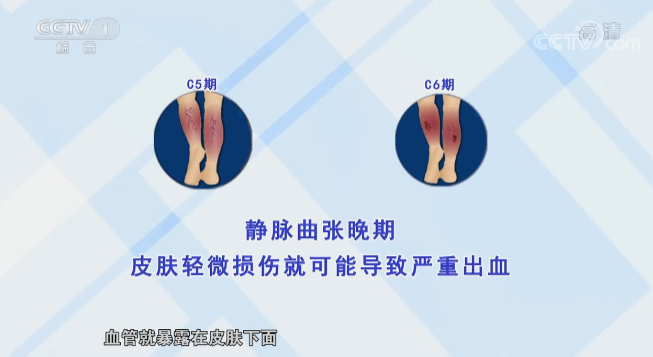 别让“蚯蚓”爬上你的腿{bbname}bbs.ahv.cc