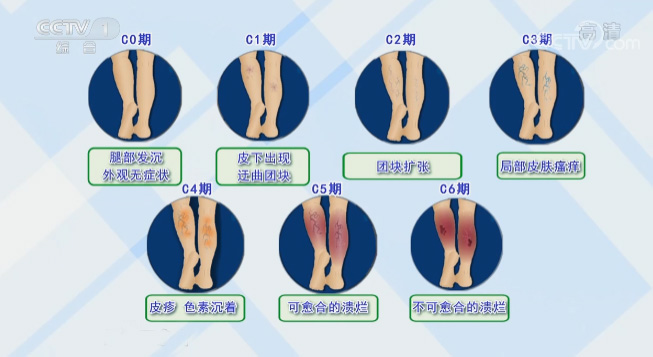 别让“蚯蚓”爬上你的腿{bbname}bbs.ahv.cc
